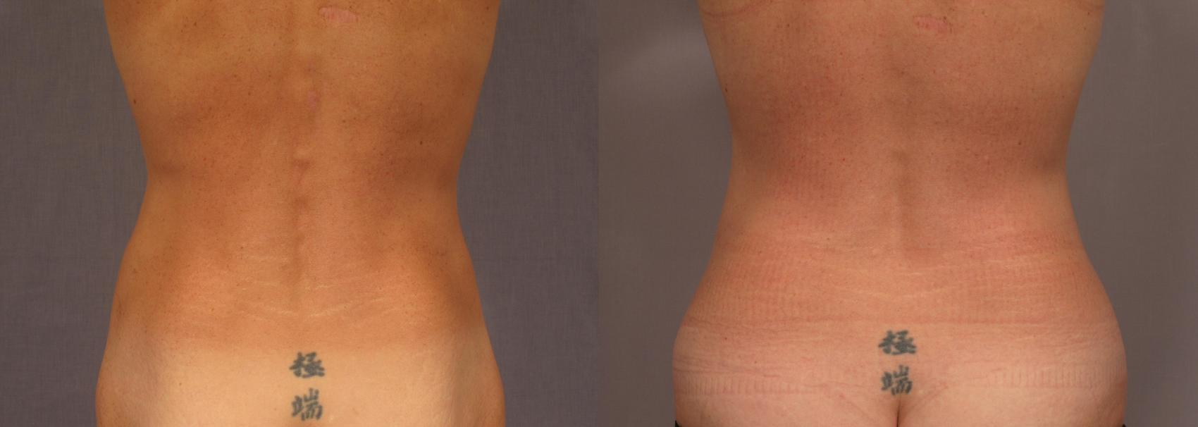 Tummy Tuck Before and After Pictures Case 326 | Naples and Ft. Myers, FL |  Kent V. Hasen, MD: Aesthetic Plastic Surgery & Med Spa of Naples