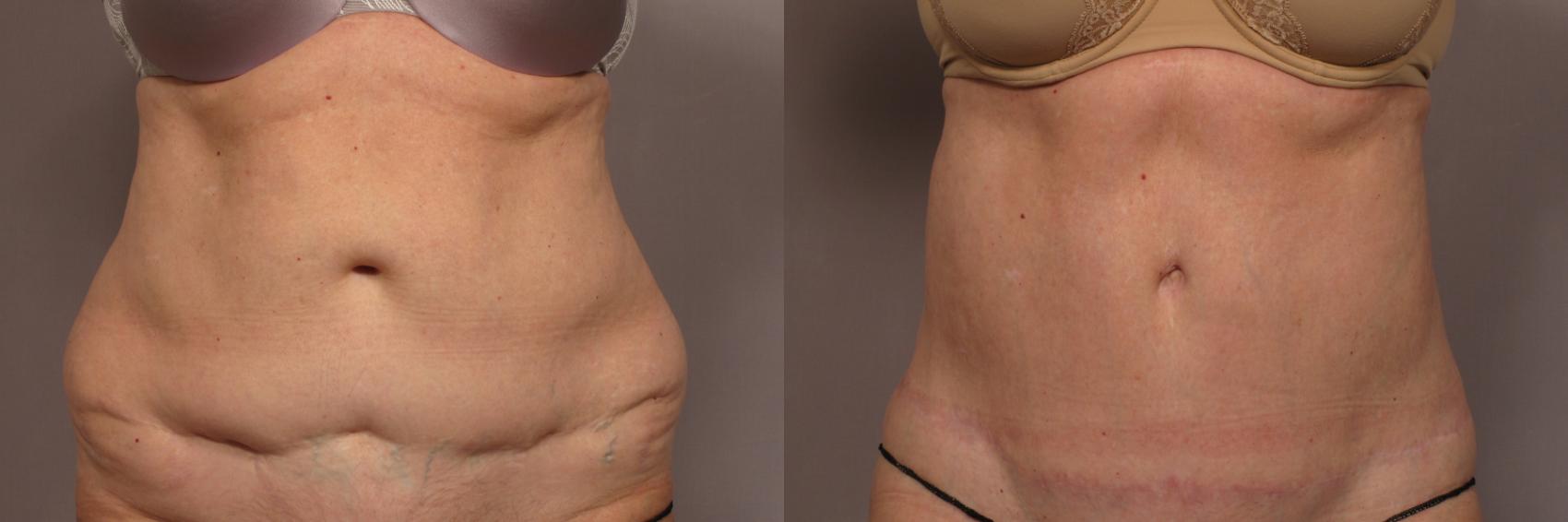Before & After Tummy Tuck Case 338 View #1 View in Naples and Ft. Myers, FL