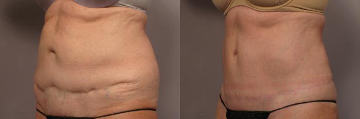 Before & After Tummy Tuck Case 338 View #2 View in Naples and Ft. Myers, FL
