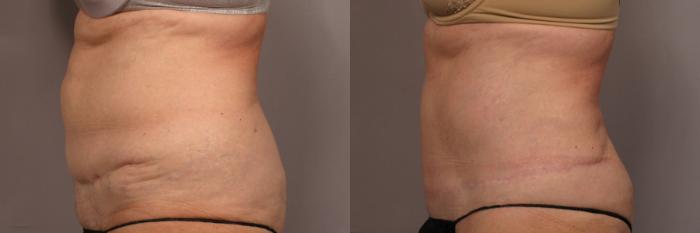 Before & After Tummy Tuck Case 338 View #3 View in Naples and Ft. Myers, FL