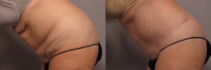 Before & After Tummy Tuck Case 338 View #4 View in Naples and Ft. Myers, FL