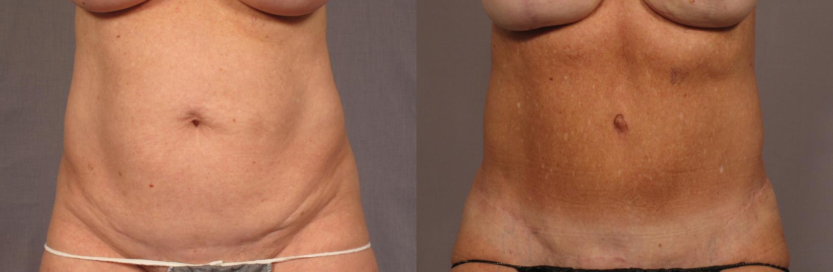 Before & After Tummy Tuck Case 356 View #1 View in Naples and Ft. Myers, FL