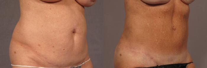 Before & After Tummy Tuck Case 356 View #2 View in Naples and Ft. Myers, FL