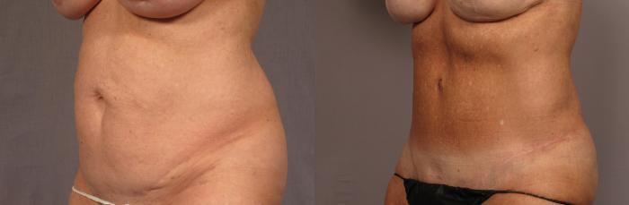 Before & After Tummy Tuck Case 356 View #3 View in Naples and Ft. Myers, FL