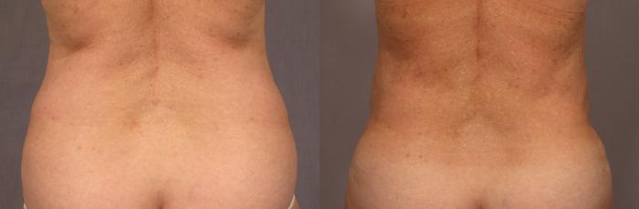 Before & After Tummy Tuck Case 356 View #5 View in Naples and Ft. Myers, FL