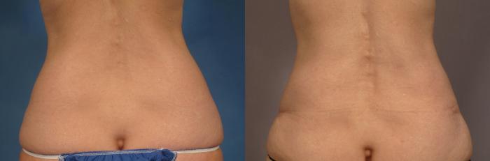Tummy Tuck (Abdominoplasty) Before and 3 years after, Posterior View