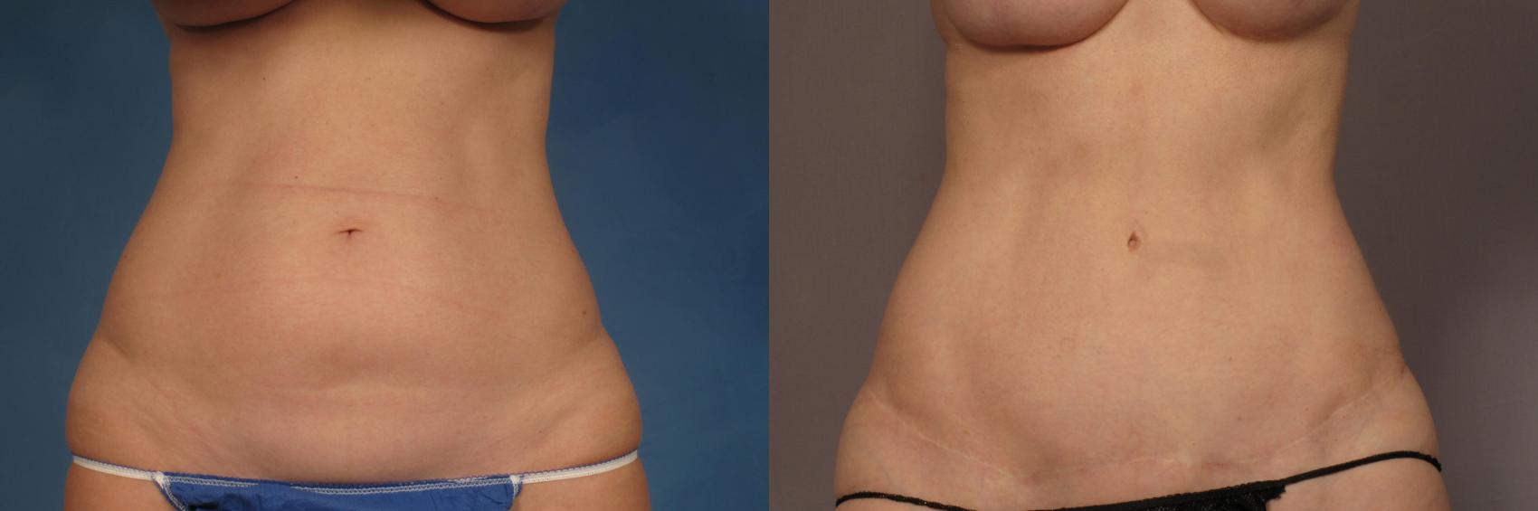 腹部整形术前和术后3年，前视图