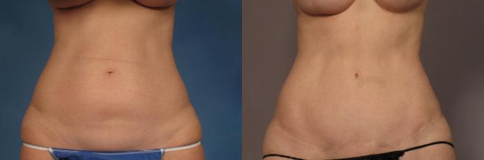 Tummy Tuck (Abdominoplasty) Before and 3 years after, Front View