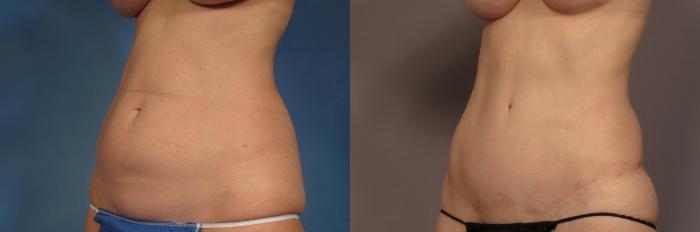Tummy Tuck (Abdominoplasty) Before and 3 years after, Left Oblique View