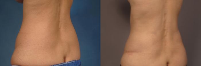 Tummy Tuck (Abdominoplasty) Before and 3 years after, Left Posterior Oblique View