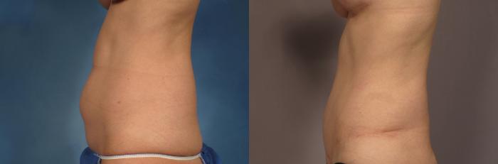 Tummy Tuck (Abdominoplasty) Before and 3 years after, Left Side View