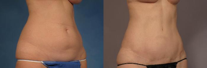 Tummy Tuck (Abdominoplasty) Before and 3 years after, Right Oblique View