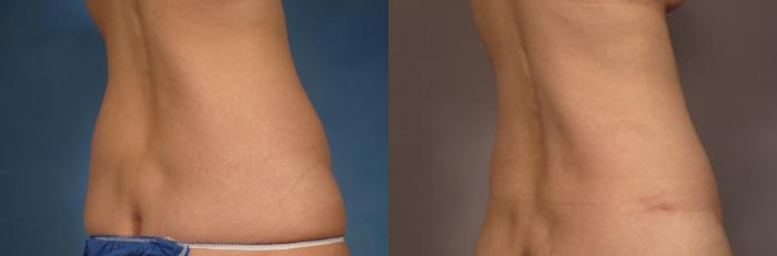Tummy Tuck (Abdominoplasty) Before and 3 years after, Right Posterior Oblique View
