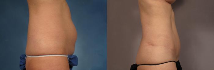 Tummy Tuck (Abdominoplasty) Before and 3 years after, Right Side View