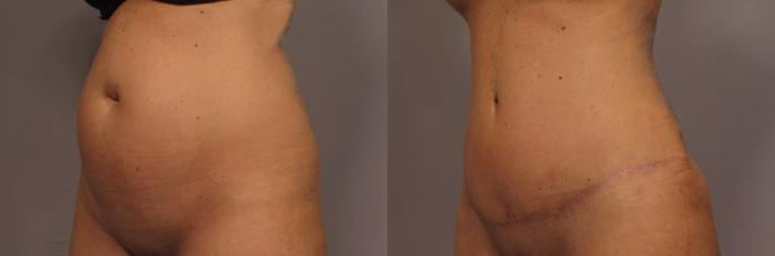 Left Oblique view, Tummy Tuck with Belly Button Hernia repair, pre-op