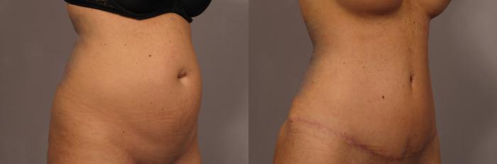 Right Oblique view, Tummy Tuck with Belly Button Hernia repair, pre-op