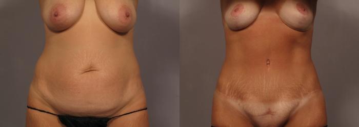 Front view of woman who underwent Mommy Makeover, pre-op