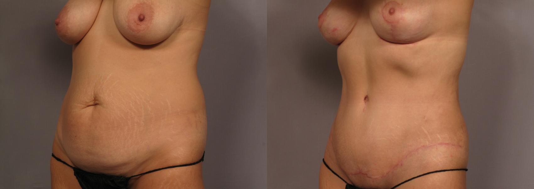 Left Oblique view of woman who underwent Mommy Makeover, pre-op