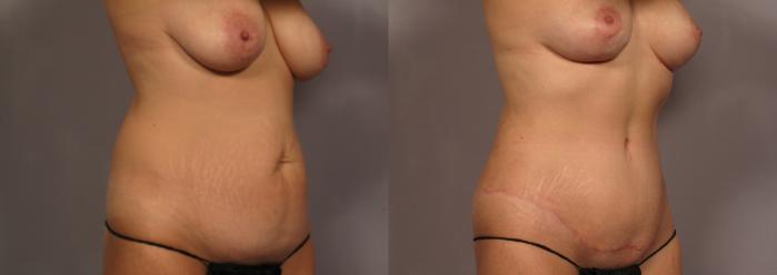 Right Oblique view of woman who underwent Mommy Makeover, pre-op