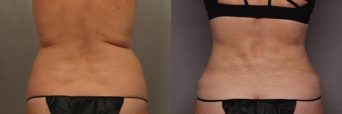 Tummy Tuck by Dr. Kent Hasen, Naples Florida, Back view,  pre-op