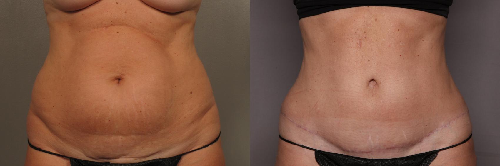 How Long Does It Take to Recover from a Tummy Tuck?