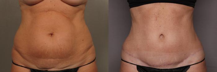 Tummy Tuck by Dr. Kent Hasen, Naples Florida, front view, pre-op