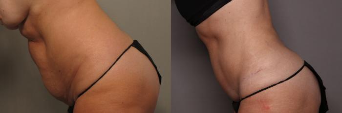 Tummy Tuck by Dr. Kent Hasen, Naples Florida, Left Side view,  pre-op