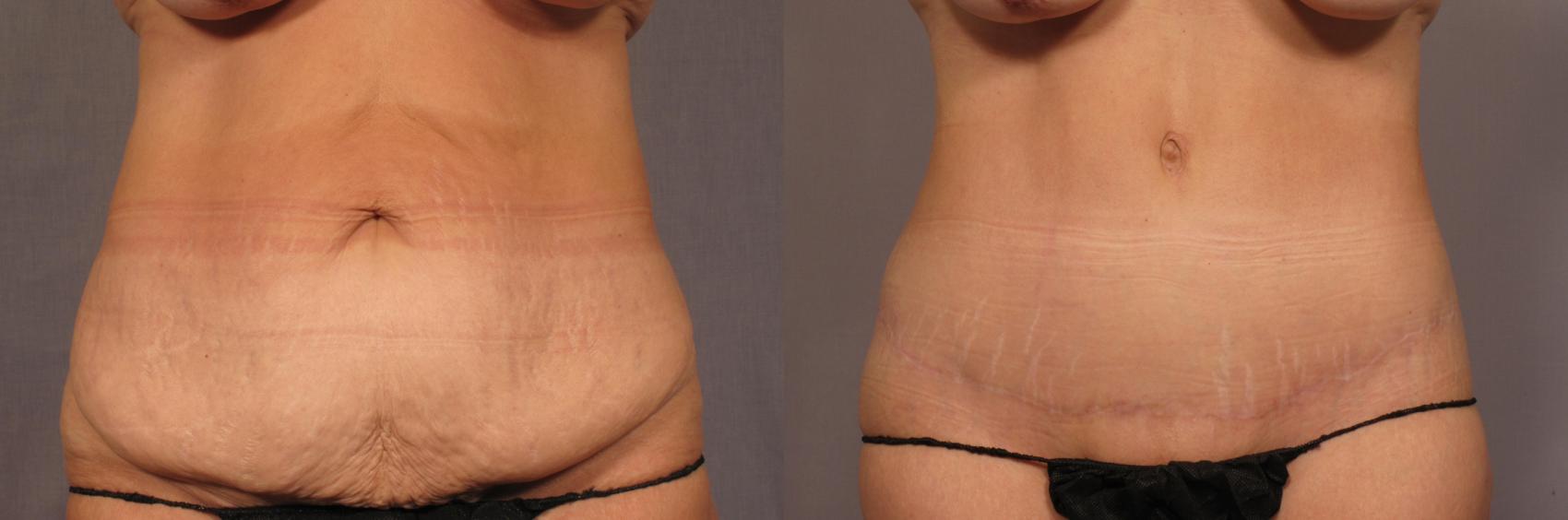Before and After Photo of Tummy Tuck with Liposuction in a 50 year old Naples, Florida woman by Dr. Kent V. Hasen