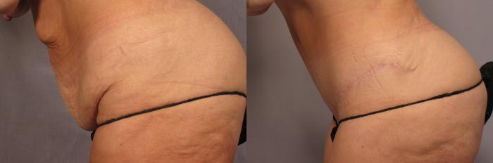 before and 9 months after Tummy Tuck and Liposuction in a 50 year old female from Naples, Florida by Dr. Kent Hasen