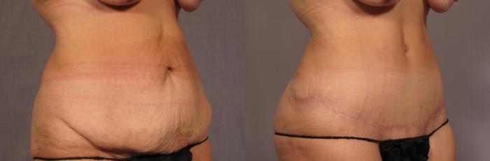 Before and 9 months after Tummy Tuck and Liposuction in a 50 year old female from Naples, Florida Oblique View