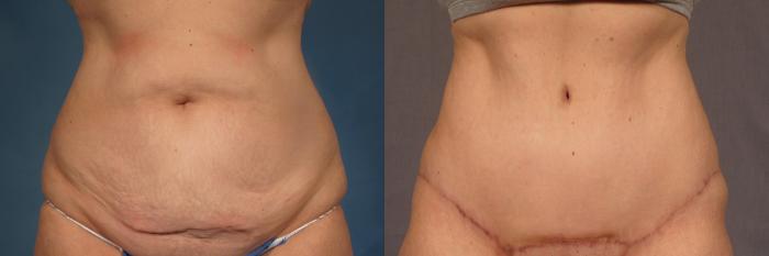 Before adn After Frontal Photo of Tummy Tuck by Dr Hasen