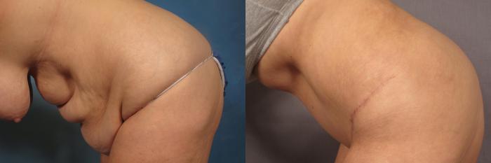 Before and 6 months after photo of tummy tuck, Left Side Down by Dr. Kent V. Hasen