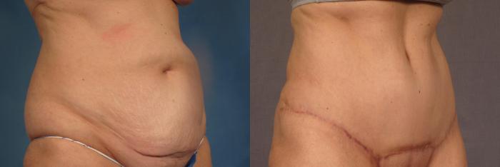 Before and 6 months after photo, Right Oblique view of tummy tuck by Dr. Kent V. Hasen