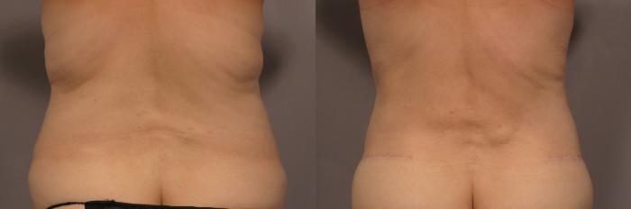 Tummy Tuck with Lipo Before and After Back View by Dr. Kent Hasen in Naples, Florida