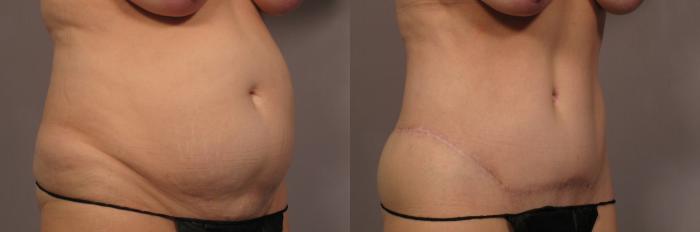 Before and 1 year After Photo of Tummy tuck Right Oblique view by Dr. Kent Hasen in Naples, Florida