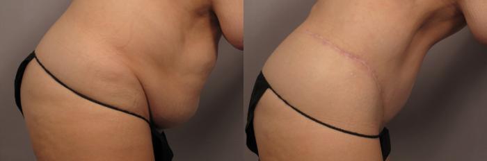 Tummy Tuck Before and After Right Side Down view by Dr. Kent Hasen in Naples, Florida