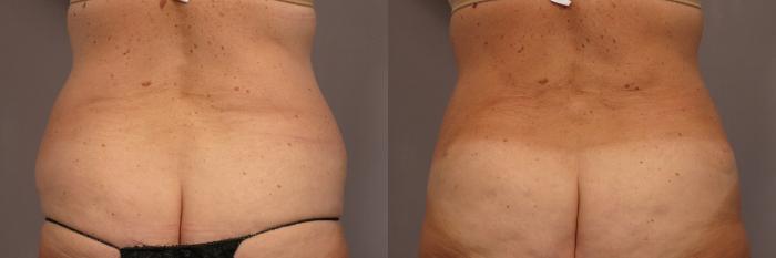 Before and After photo, Posterior View at 1 year after Tummy Tuck and Liposuction by Kent V. Hasen, MD