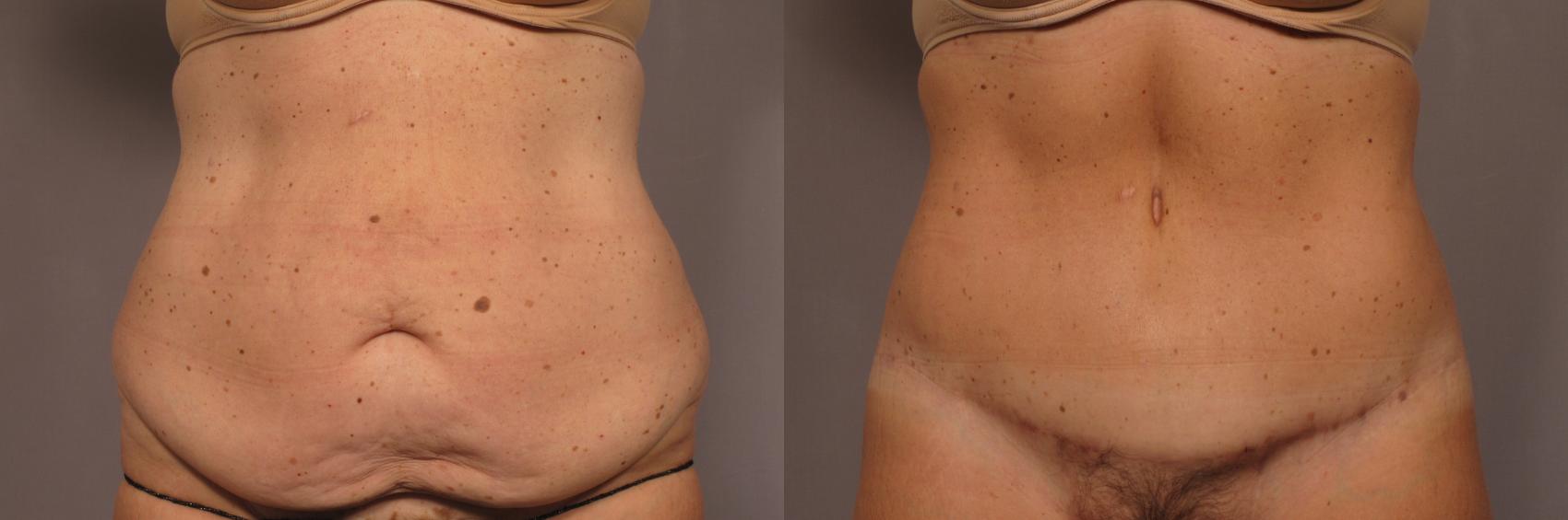 Tummy Tuck: Mistakes to Avoid After the Procedure