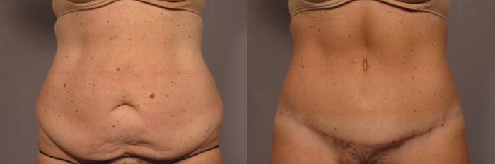 Tummy tuck, before and after 1 year, frontal view, Dr Kent Hasen