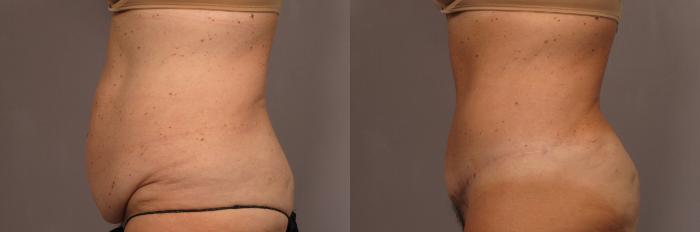 Before and After photo Left Side at 1 year after Tummy Tuck by Kent V. Hasen, MD