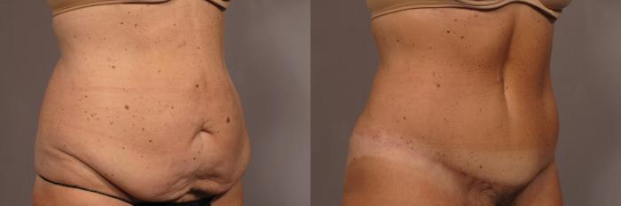 Before and After photo Right Oblique at 1 year after Tummy Tuck by Kent V. Hasen, MD