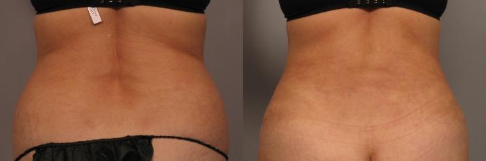Tummy Tuck and Liposuction, Before and 3 Months After, Back View Photos by Dr. Kent V. Hasen