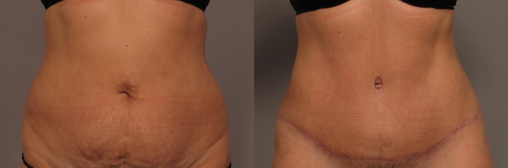 Tummy Tuck, Before and 3 Months After, Frontal View Photos by Dr. Kent V. Hasen