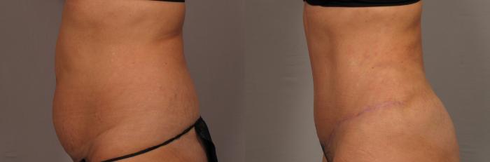 Tummy Tuck, Before and 3 Months After, Left Side View Photos by Dr. Kent V. Hasen