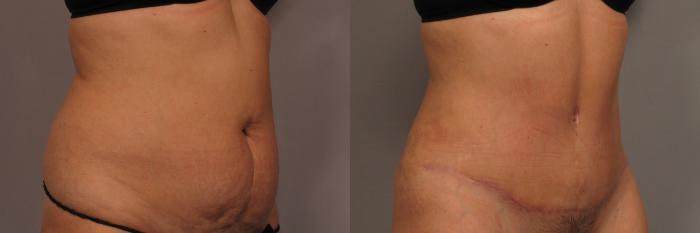 Tummy Tuck, Before and 3 Months After, Right Oblique View Photos by Dr. Kent V. Hasen