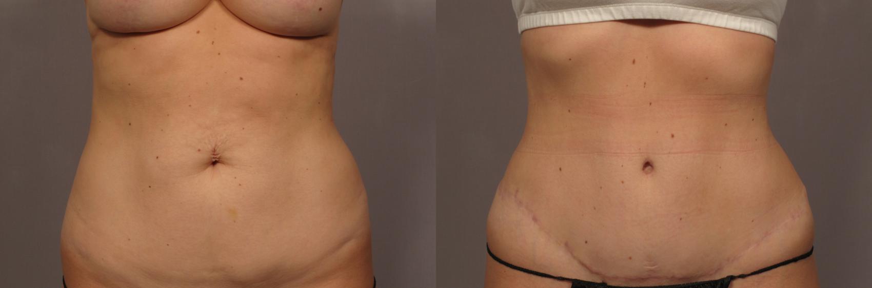 Tummy Tuck, Frontal View, Before and After 1 year photos, Dr. Kent Hasen