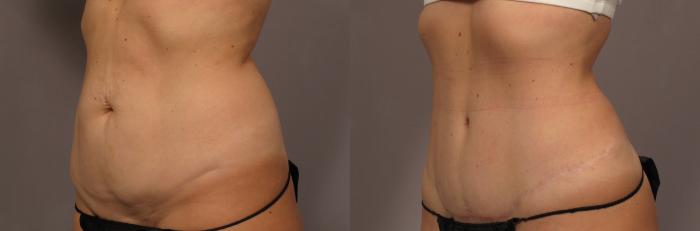 Tummy Tuck, Left Oblique View, Before and After 1 year Photos, Dr. Kent Hase