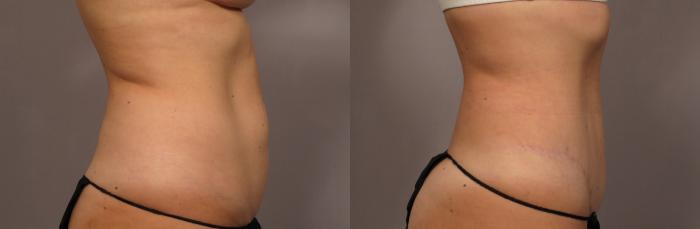 Tummy Tuck, Right Side View, Before and After 1 year Photos by Dr. Kent Hasen
