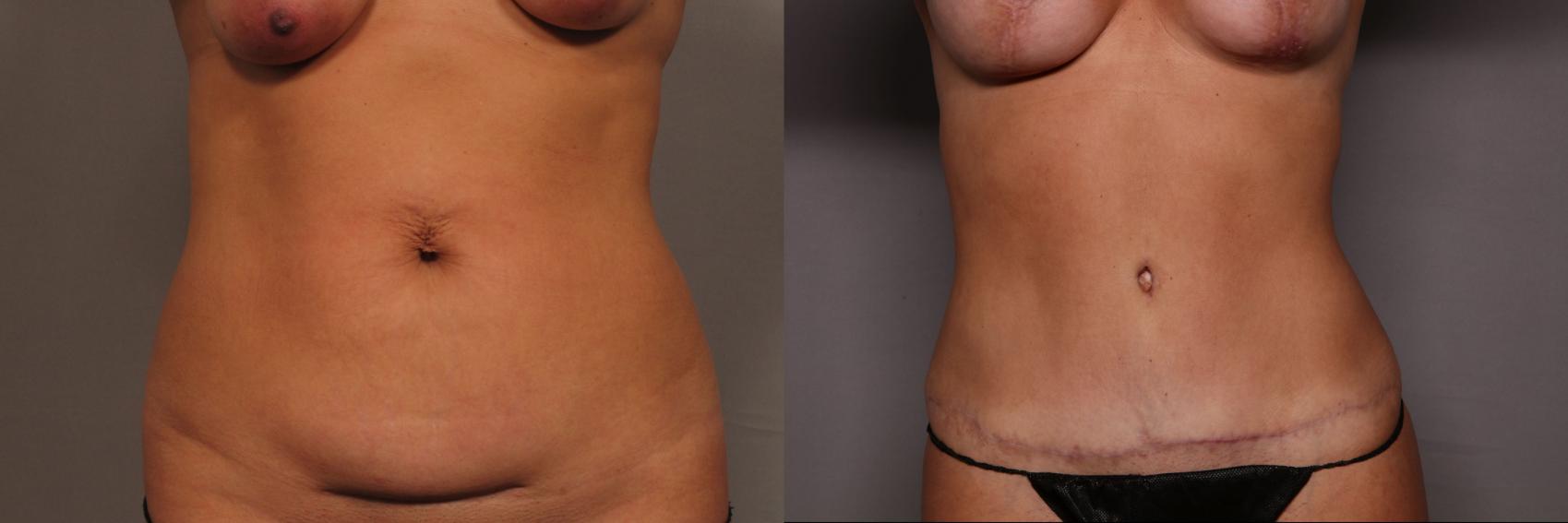 Before & After Tummy Tuck Case 464 Front View in Naples and Ft. Myers, FL