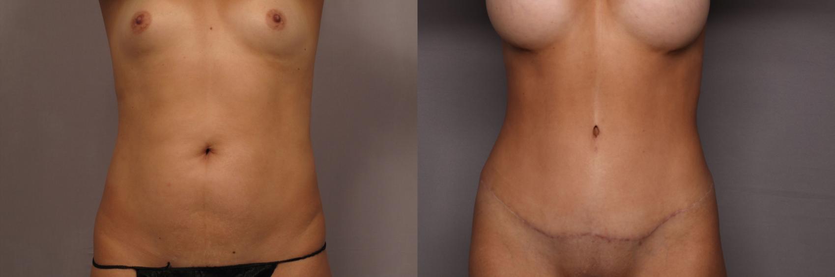 Before & After Tummy Tuck Case 466 Front View in Naples and Ft. Myers, FL